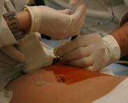 Amniocentesi