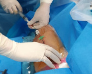 Ospedale Impianti venosi